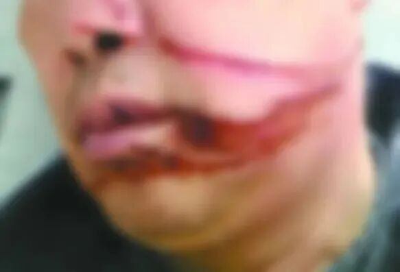 盘先生脸部被风筝线划伤。图源：南充市应急管理局