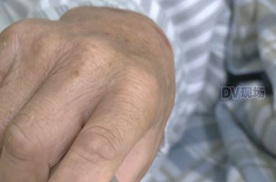 广州一老人3月得热射病进ICU