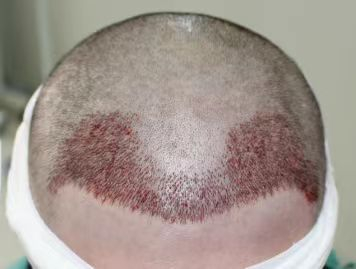 植发后，如果不能及时清洁头皮，它会有血痂形成，不仅容易造成感染，可能还会影响种植毛囊的生长。