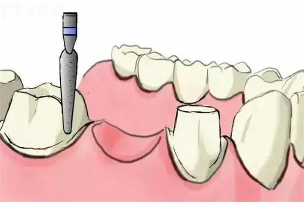 牙科玻璃离子怎么去除贵州牙科医院价格表：种植牙2280+牙齿矫正7500+镶牙冠800+补牙120+_口腔医院报价价格表-牙舒丽网_https://www.jmylbn.com_新闻资讯_第3张