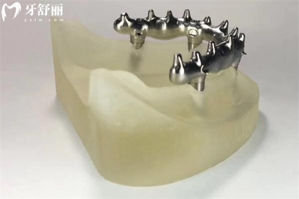 牙科玻璃离子怎么去除贵州牙科医院价格表：种植牙2280+牙齿矫正7500+镶牙冠800+补牙120+_口腔医院报价价格表-牙舒丽网_https://www.jmylbn.com_新闻资讯_第2张