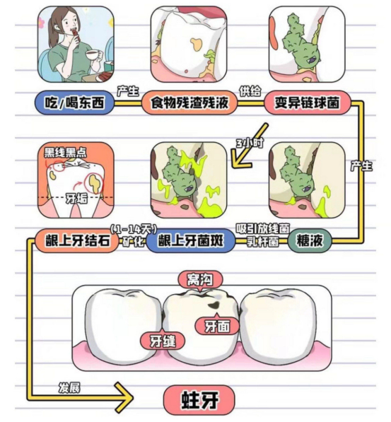牙石形成示意图：