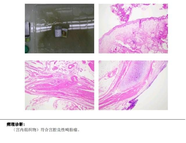 膨宫是什么一女子体检查出罕见肿瘤,医生:从出生时就存在_新闻资讯_第1张_活检穿刺产品网 膨宫是什么一女子体检查出罕见肿瘤,医生:从出生时就存在_https://www.jmylbn.com_新闻资讯_第1张