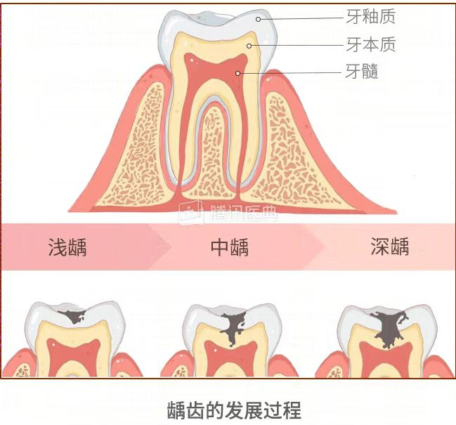 图源：腾讯医典