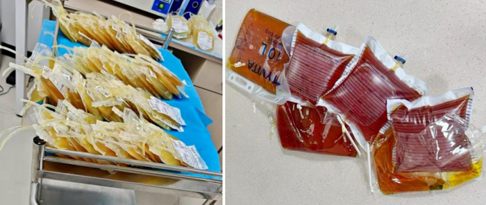 ▲治疗血浆（左图）及新型人工肝毒物清除治疗滤出的废液