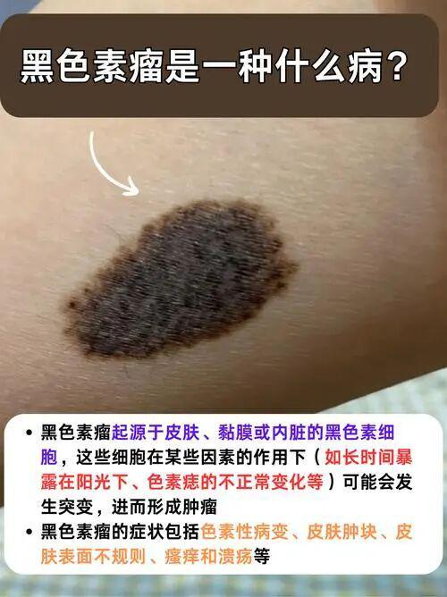 教你区分黑色素痣和黑色素瘤|黑痣|墨迹|肺转移|瓦片|沙地_新浪新闻