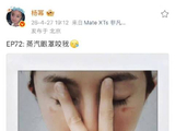 杨幂发微博称被蒸汽眼罩烫伤，晒出红印