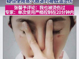 张馨予分享被蒸汽眼罩烫伤经历