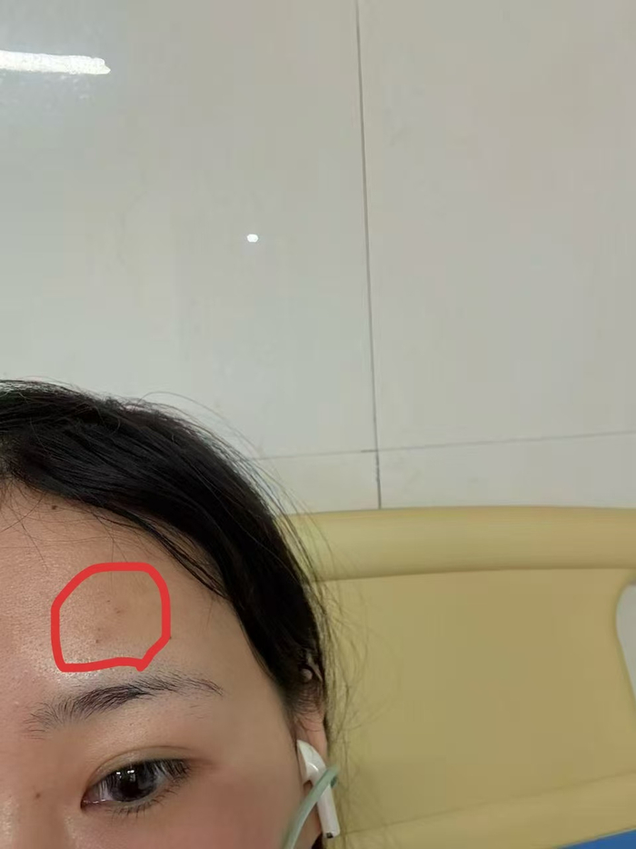 李佳芸（化名）脸上的灼伤。 受访者供图