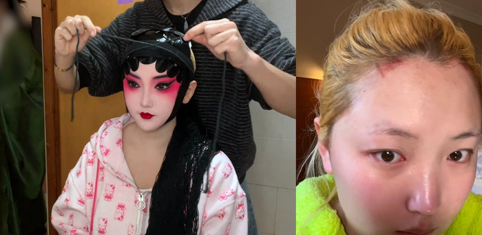 圆子最多的一天勒了16个半小时的头，起了一堆水泡。  受访者供图