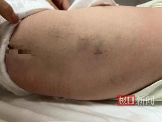新生儿遭美悦湾月子中心护工拍打 后续被诊断中枢性协调障碍(图1) 孩子背部发现淤青(受访者供图)
