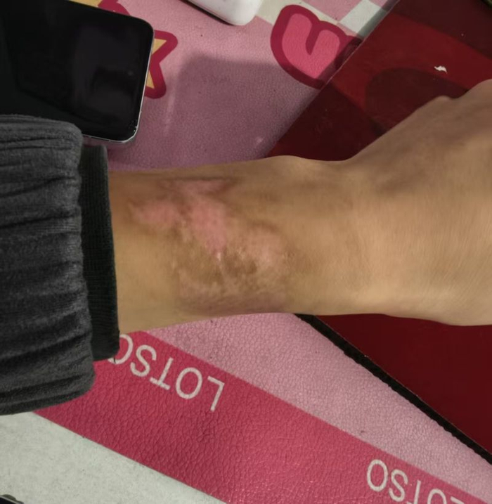 6月12日，刘郡（化名）手腕上因被绑留下的伤疤。 受访者供图