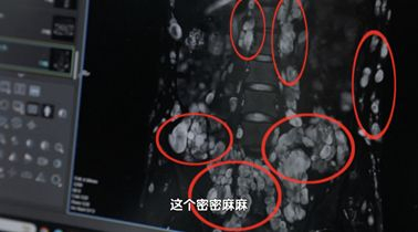 图1 丹丹体内肿瘤影像（微博截图）
