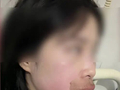新娘婚礼前两天被马蜂蜇伤，嘴唇肿胀自嘲“像蛤蟆精”，当事人：婚礼如期举行