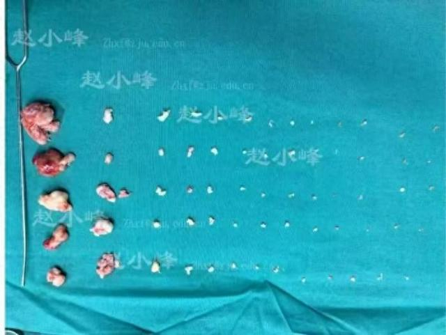 图：患者子宫腔内“挖”出68个肌瘤 赵小峰团队供图