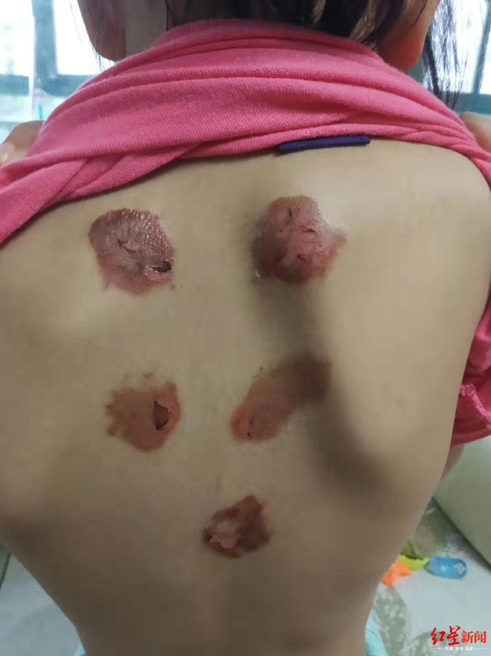 ↑贴完“三伏贴”后，多名孩子被灼伤