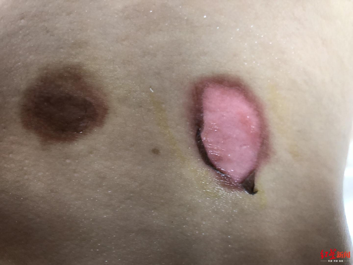  ↑7月13日，贴完“三伏贴”后，吴敏的孩子被灼伤