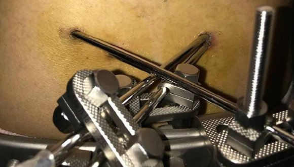 插入刘玉立身体的腰针。图片来源：受访者提供