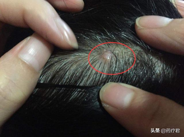 头皮上总“长痘痘”,抠破还疼?暴露出3大“问题”,一定要重视