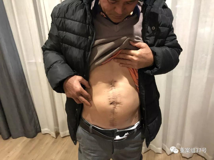  子弹击穿吴方强腹部，留下一尺长的手术疤痕。&nbsp;新京报记者 卢通 摄