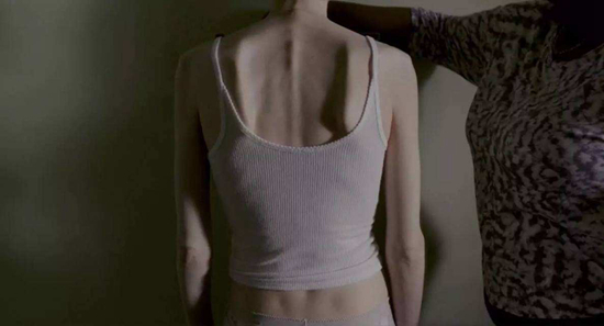 2017年上映的美国电影《骨瘦如柴》，讲述了患有厌食症的女子在医生激励下，直视疾病与其斗争的故事。电影的导演马蒂·诺克森曾一度厌食到心脏骤停，女主角莉莉·柯林斯也曾患有厌食症。电影剧照