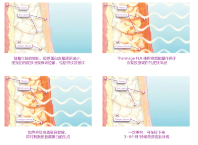 热玛吉原理示意图（图片来源：热玛吉官网）