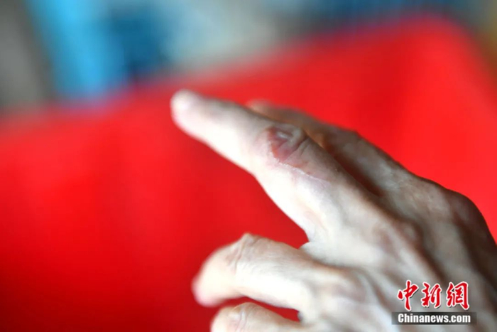 因有时被流浪狗误伤释，释寅定和释寅慧的手和脚布满伤痕。中新社记者 吕明 摄