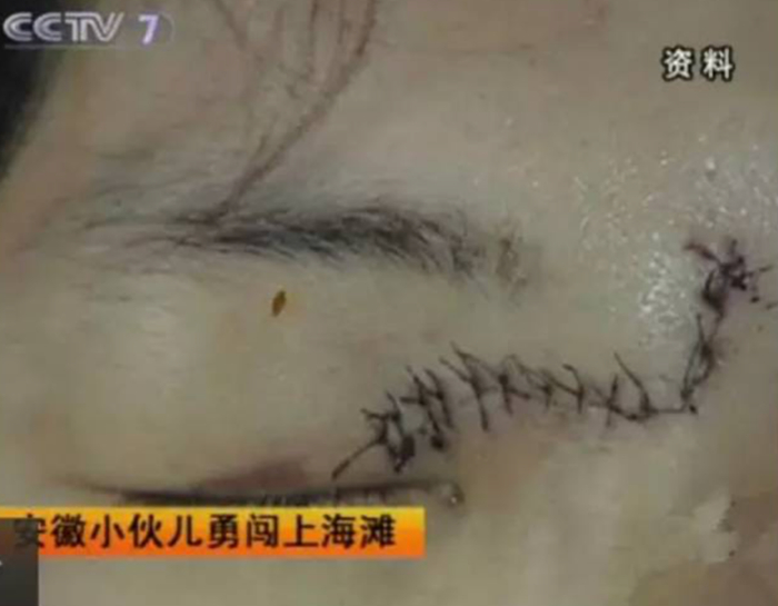  ·刘会平的伤口