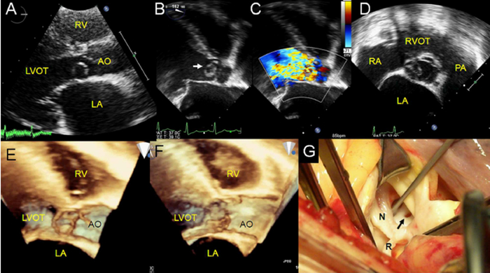 ▲罕见主动脉窦瘤破入左室流出道。经胸联合经食道超声显示主动脉瓣环附近囊性病变（白色箭头）、形变和动度、起源等诊断主动脉窦瘤，通过瘤体脱入左室、瓣环和窦壁分离等个性特征确定其亚型，并被手术证实。