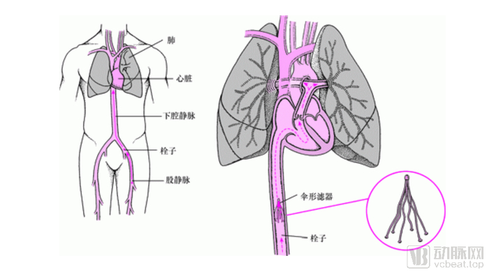 下腔静脉滤器预防肺栓塞原理 图源：默沙东诊疗手册