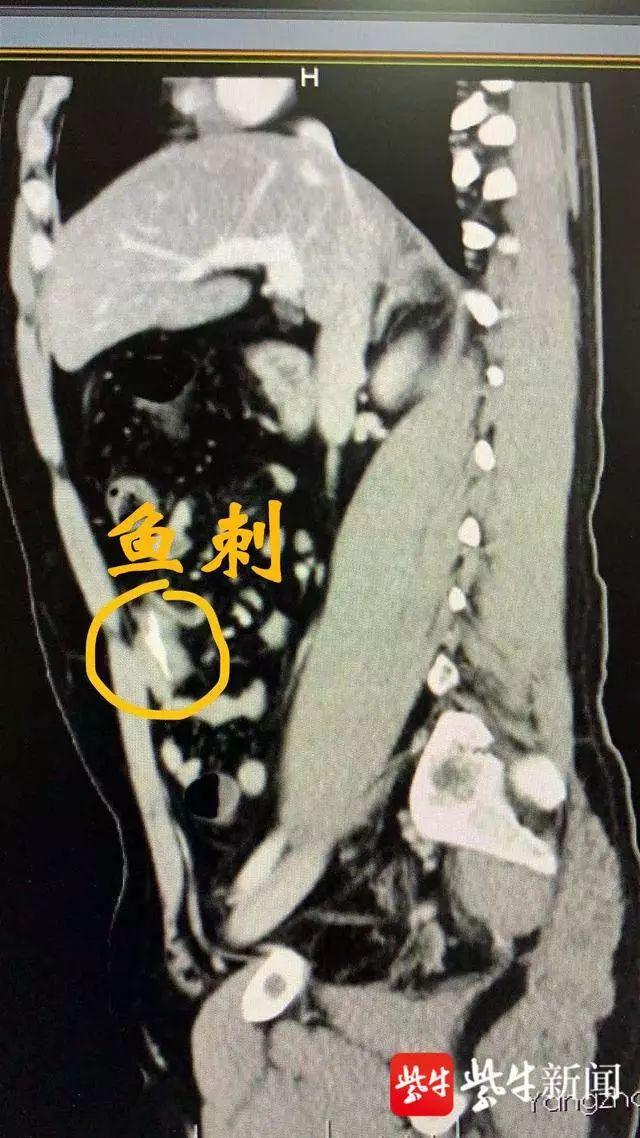 腹痛难忍！4厘米长大鱼刺在肚中“游走”