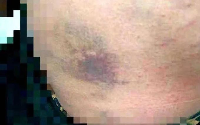 刘娟身体多处挫伤