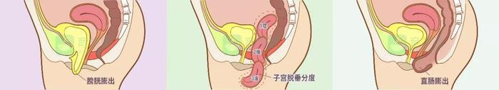 如何避免产后漏尿、脱垂和松弛？最重要的是做好这项检查