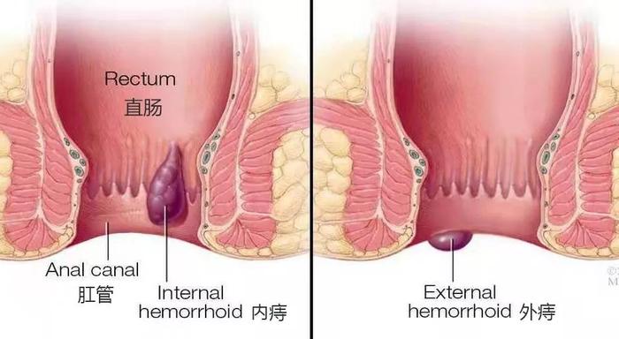 做痔疮手术时放了个屁，崩了医生一脸血...