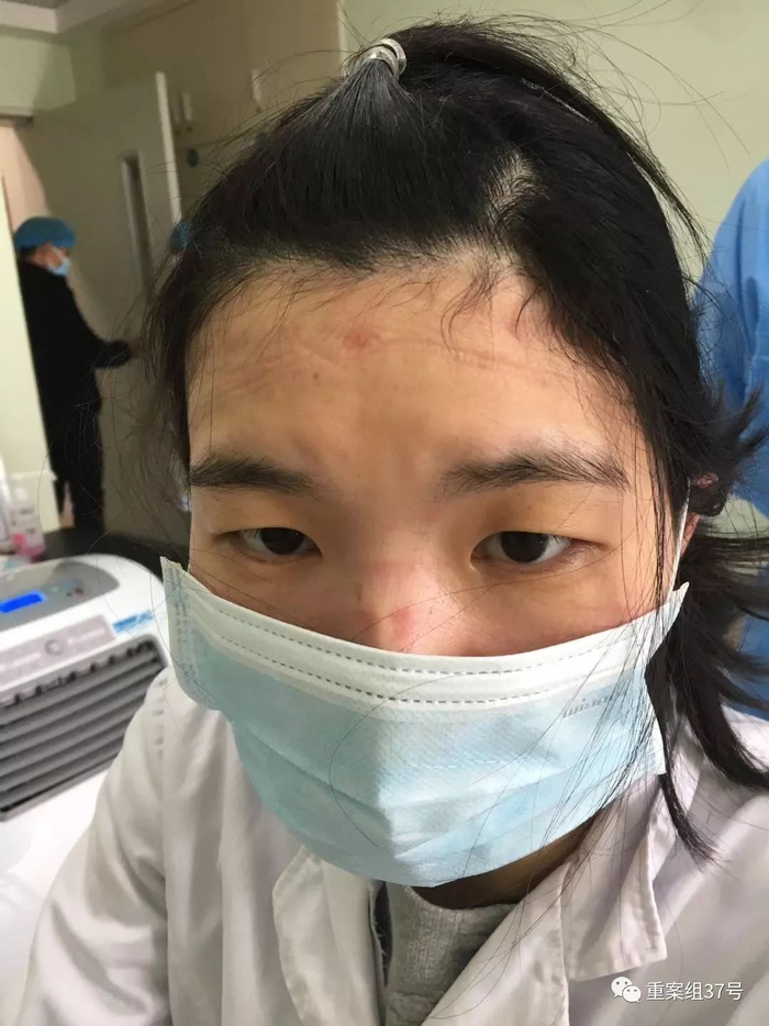  ▲工作一天后，脱下防护服、面罩的胡纤脸上压痕累累。