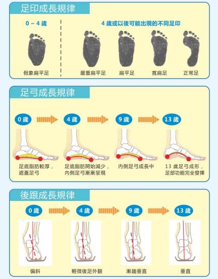 扁平足不是小问题，矫正鞋垫可干预