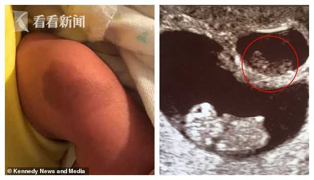 右图为另一胚胎10周时的超声波影像