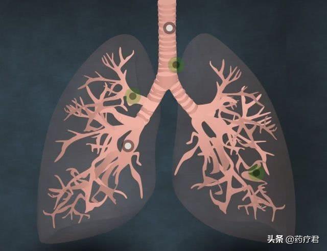 咳嗽，不一定是感冒，若伴有这2个症状，最好做一下肺部检查