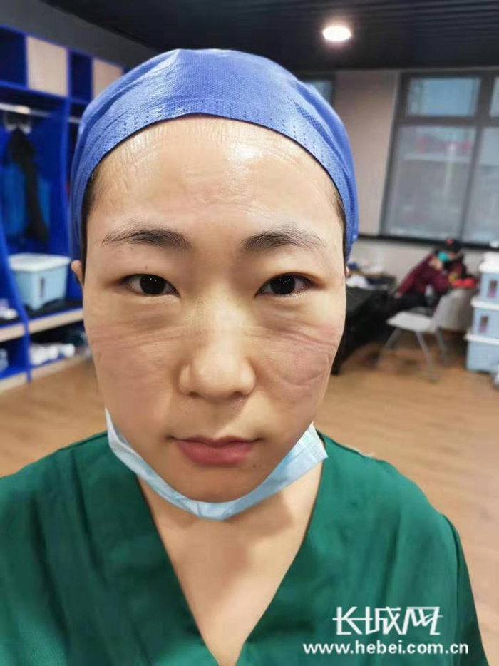  脱下防护服的马玉洁，脸上满是压痕。