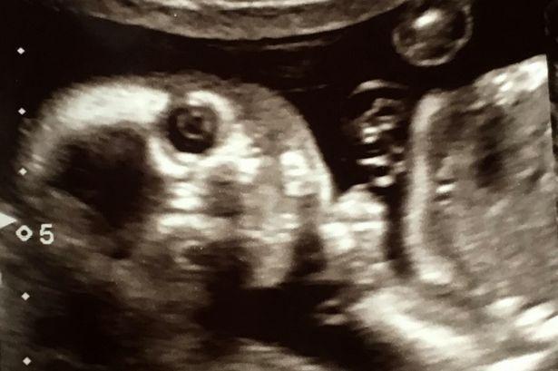英国妈妈怀孕20周行孕期检查，B超中宝宝直视“摄像机”做鬼脸