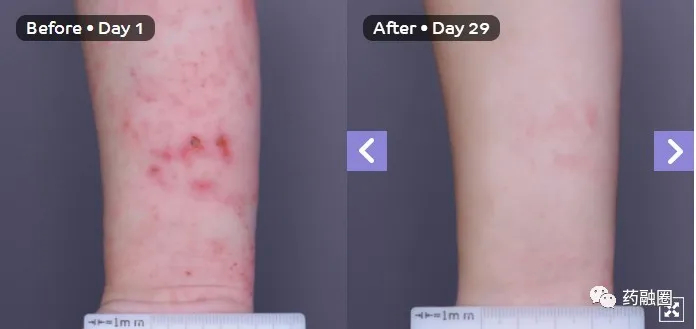 临床试验时，湿疹患者用药前后真实对比图，需要说明的是可能有个体差异。
