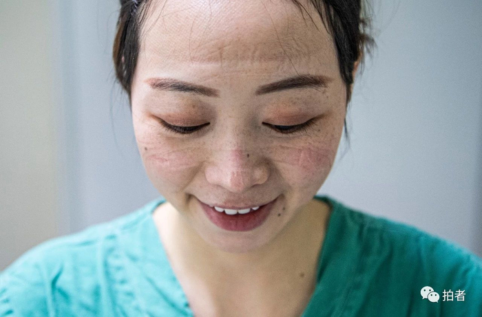  △&nbsp;工作一天后，卸下防护装备的武汉协和医院肝胆-胰血管外科的护士覃芳芳脸上满是印痕。摄影/新京报记者陶冉