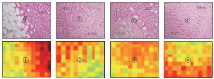图为乳腺癌的病理学图像和太赫兹图像（均为乳腺癌组织的局部放大100倍后的图像）
