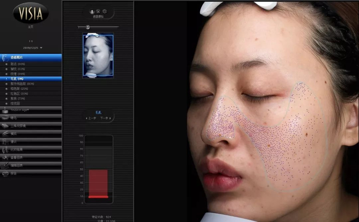 △只有第7代专业美容仪VISIA才能检测到在皮肤毛囊口的“毒素”