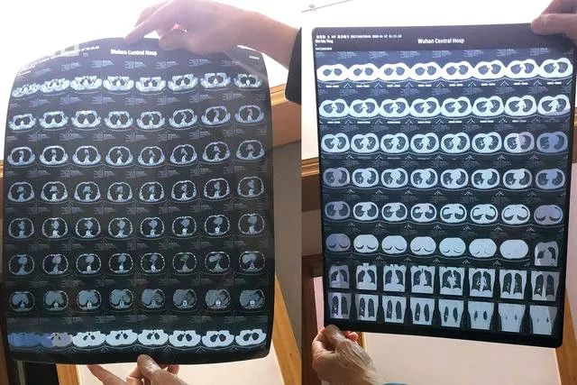 父亲（左）和李悦（右）的CT结果 受访者供图