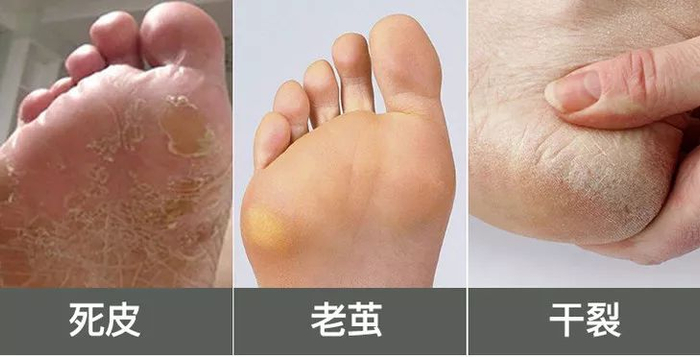 ▲走路、运动、穿高跟鞋，都容易让脚底堆积死皮、老茧。