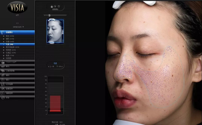△只有第7代专业美容仪VISIA才能检测到在皮肤毛囊口的“毒素”