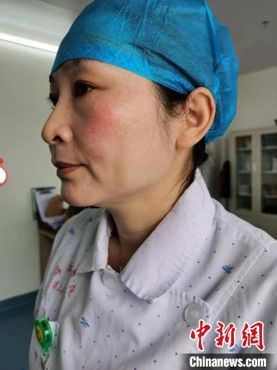 医护人员脱下面罩和口罩后留下深深印记。　海医二院供图