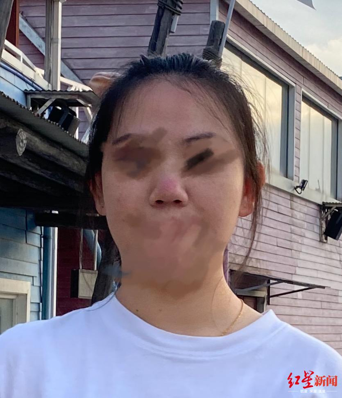 ↑张女士的朋友鼻子出现红块