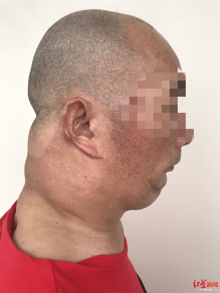 马德龙病